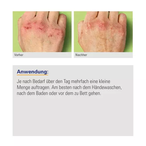Zusatzbild Hautschutz-Set, Handcreme und Fingerverband, ist ein Hautschutz gegen Risse, die mehrfach am Tag angewendet werden sollte für die Erholung der Haut.